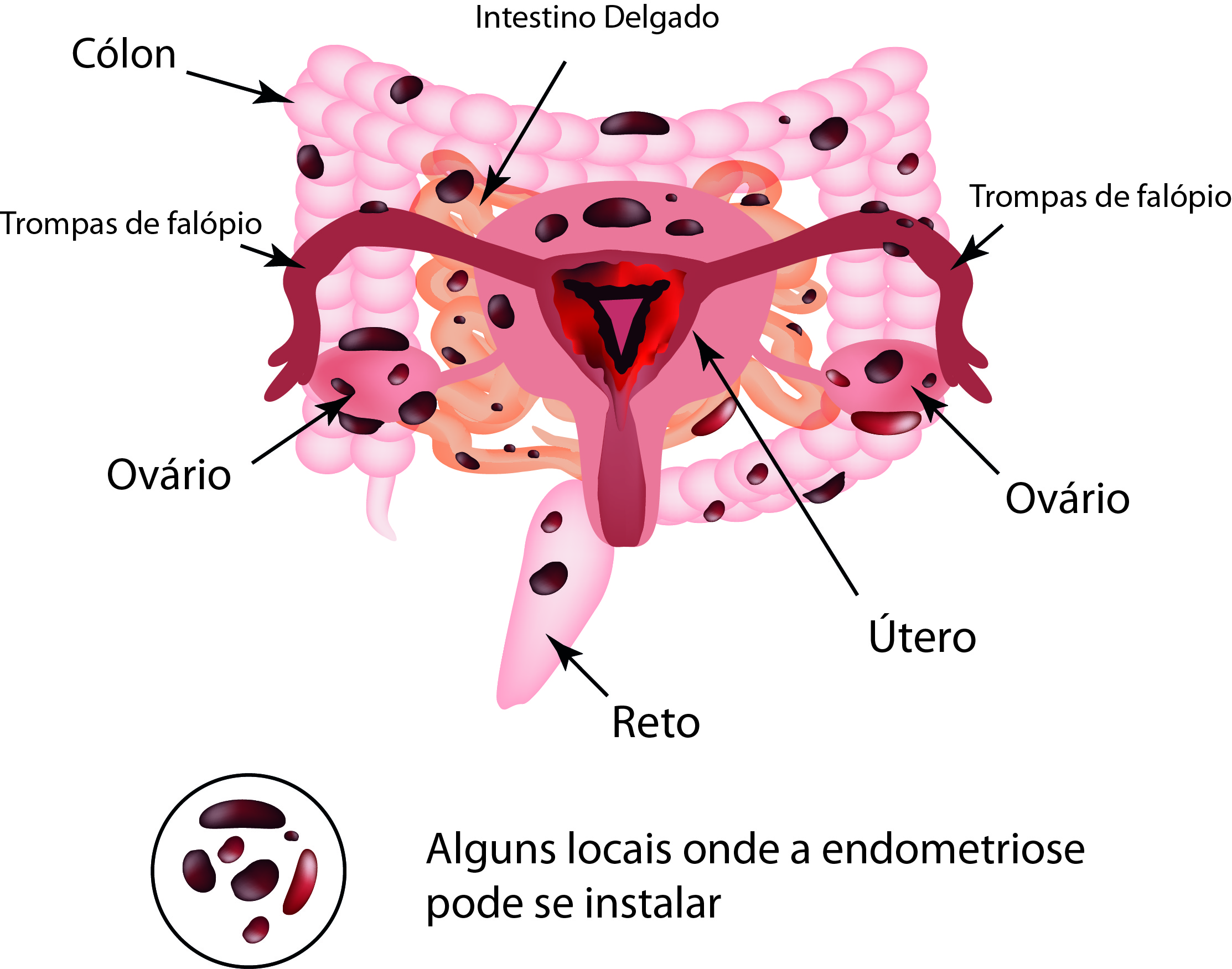 Endometriosis profunda