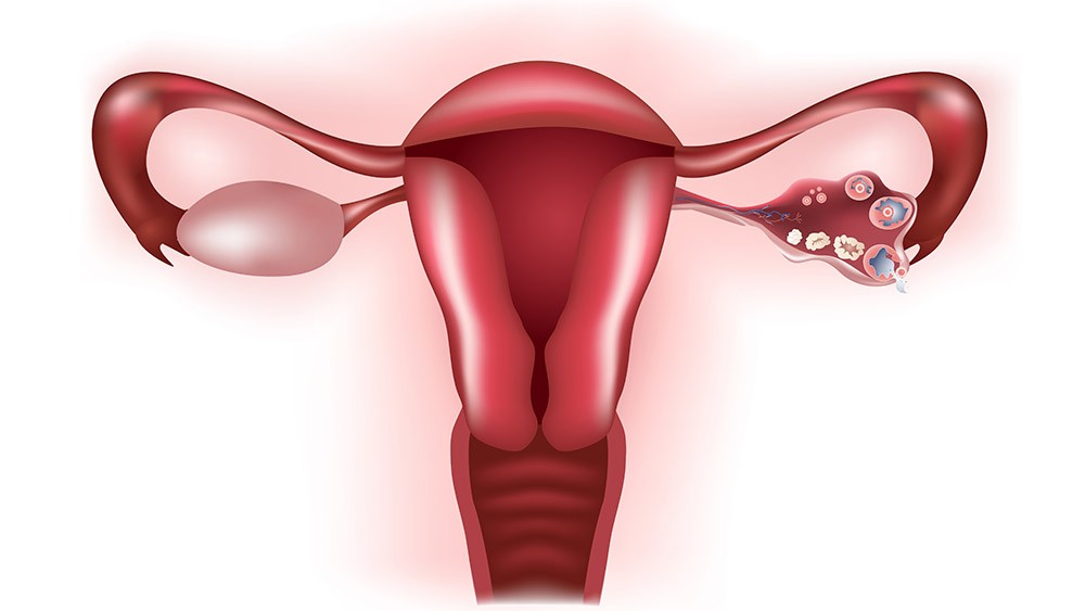 A cirurgia da endometriose pode afetar a reserva ovariana da mulher?