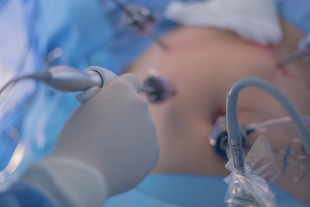 Videolaparoscopia - Instituto Crispi de Cirurgias Minimamente Invasivas